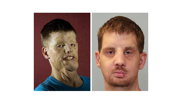 Mitch Hunter Before and After Photos