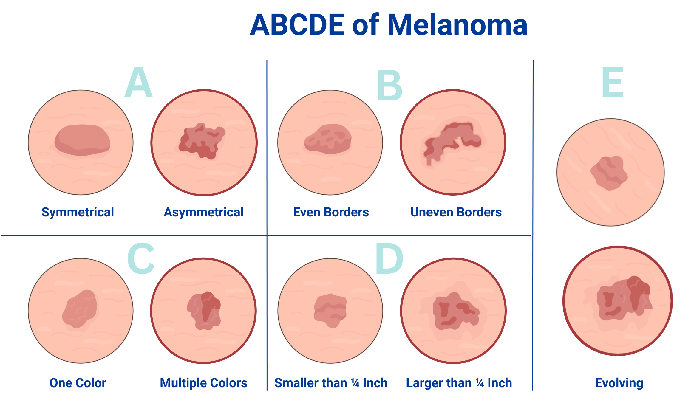 ABCDE of Melanoma (visual symptoms)