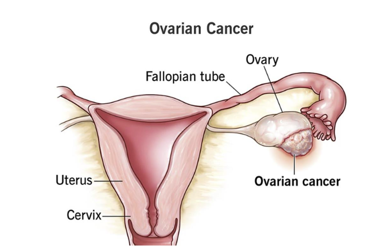 Anatomy of ovarian cancer.