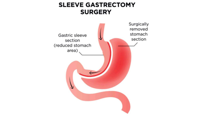 The Perfect Sleeve Gastrectomy