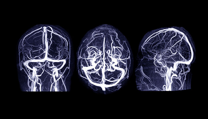 A scan revealing a brain aneurysm
