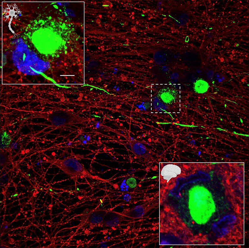 An electron micrograph image depicting protein aggregates in green and and postmortem tissue from the brain of a patient with Parkinson's disease