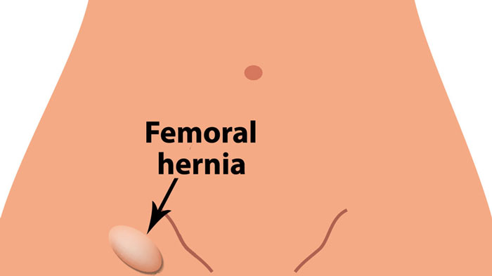 Groin Hernias in Women - A Review of the Literature