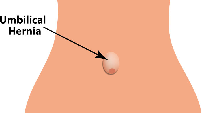 Umbilical Hernia in Females Post Pregnancy