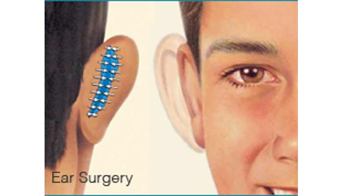 Cosmetic Ear Surgery - Brigham and 