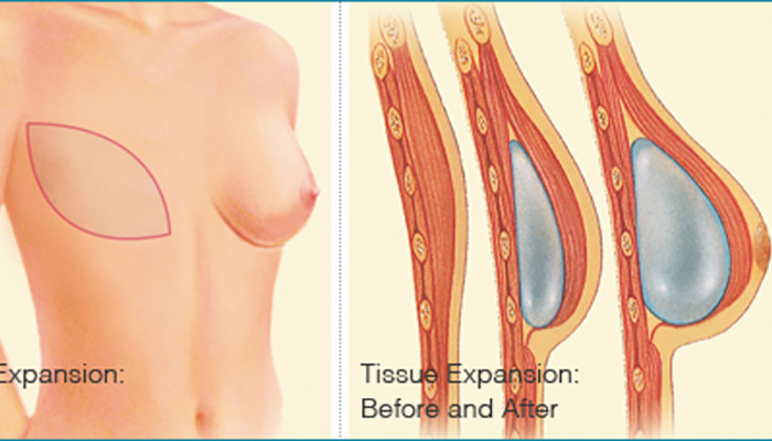 Complete resection of the nipple before and after double purse