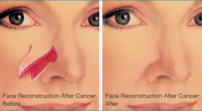 face-reconstruction-after-cancer-brigham-and-women-s-hospital