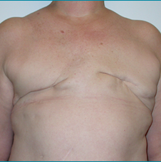 Breast DIEP Reconstruction Before & After - Brigham and Women's